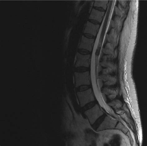 Sagital T1-weighted MRI of the lumbar spine disclosed a 2 x 1 cm ...