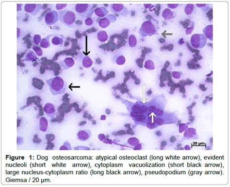 Histology Of Osteosarcoma