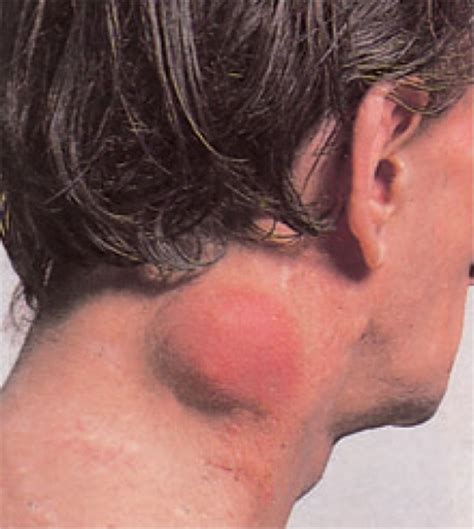 Lymphoma In Neck | Non hodgkins lymphoma, Non hodgkins lymphoma ...