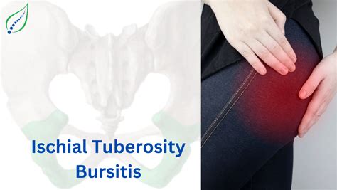 Ischial Tuberosity Bursitis: Causes, Symptoms & Treatment Options ...