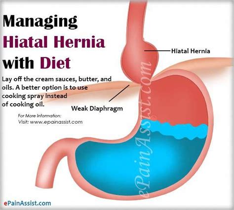 Pin by Kristi Evridge on Hernia in 2020 | Hiatal hernia diet, Hiatus ...