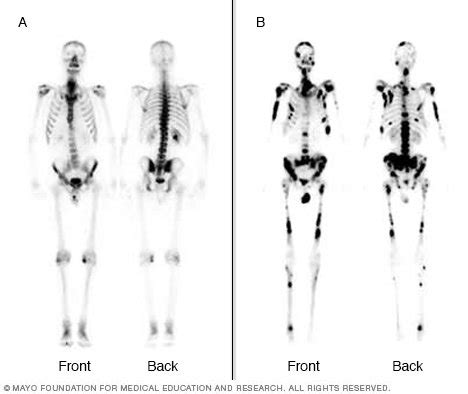 Bone scan - Drugs.com