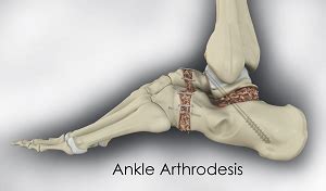 Ankle Arthrodesis | Ankle Infection