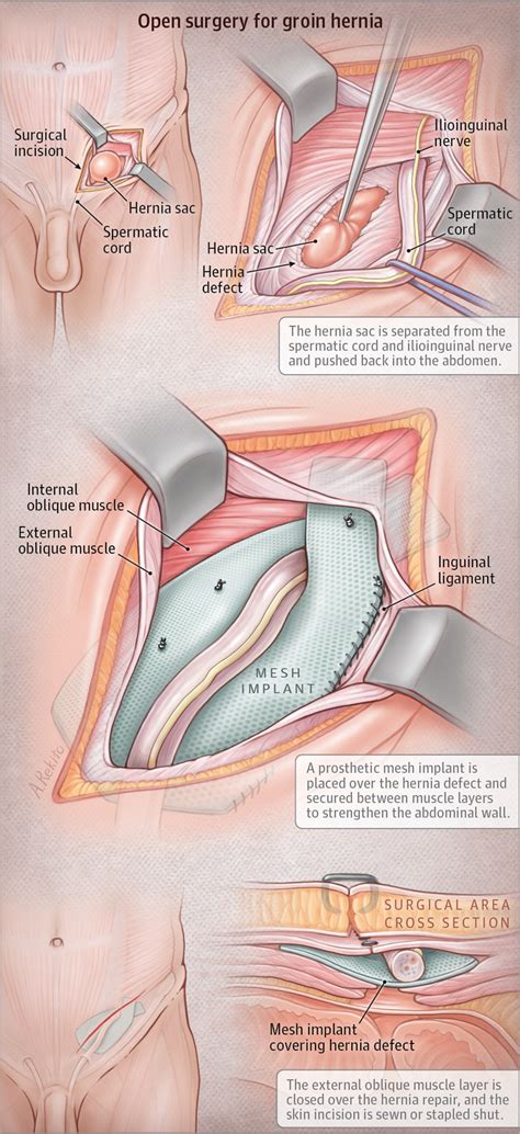 Groin Hernia Repair by Open Surgery. | Surgery | JAMA | JAMA Network