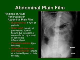 Imaging acute pancreatitis | PPT