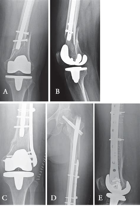 a, b) AP and lateral x-rays showing a distal femur periprosthetic knee ...