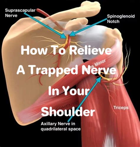 How to Relieve a Trapped Nerve in Your Shoulder | Patient's Lounge