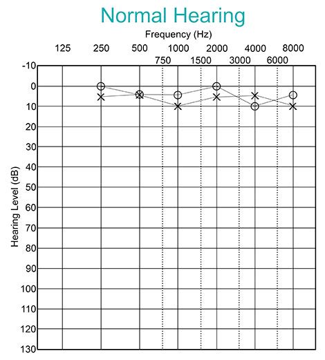 What Is An Audiogram? - My Baby's Hearing