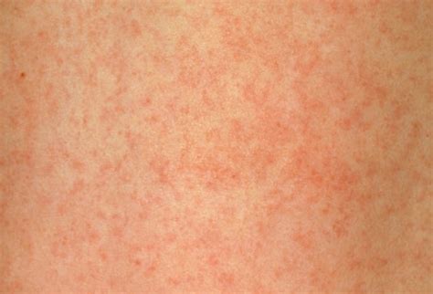 Meningitis Rash - Pictures, Symptoms, Treatment, Causes