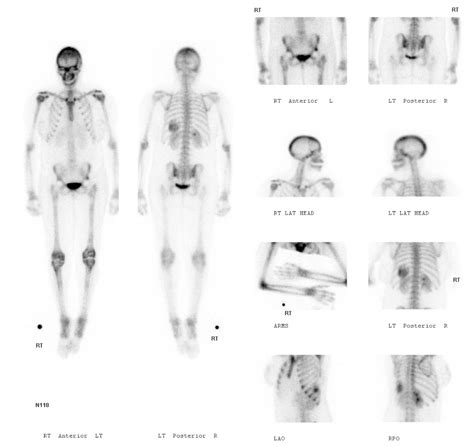 bone-scan-2 | NucsRadiology.com