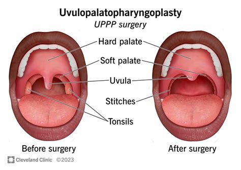 Uvula Anatomy