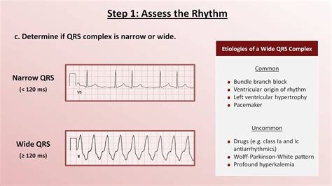 Www ecg interpretation