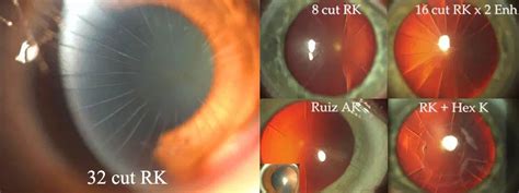 Radial Keratotomy Jacksonville | Gulani Vision Institute