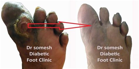 Diabetic Gangrene stages-Great Toe Base - Podiatry Doctor