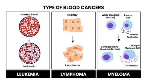 Blood Cancer Types