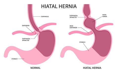 Hiatal Hernia | Advocate Health Care