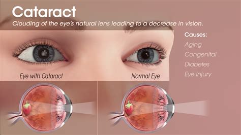 Cataract shown in human eyes using medical animation still shot