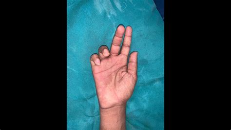 Ulnar Claw Hand Correction - YouTube