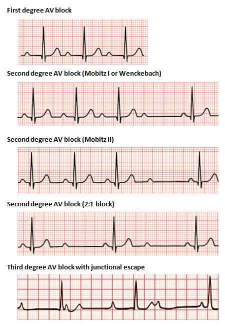 Heart block - Wikipedia