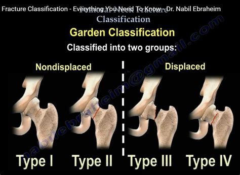 Femoral Neck Fracture Classifications Everything You Need, 49% OFF