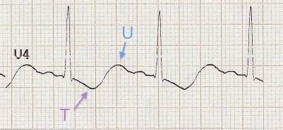 Hypokalaemia ECG changes • LITFL • ECG Library