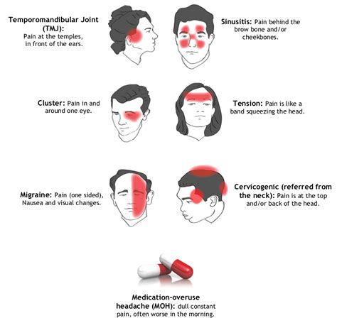 Common types of headaches and triggers | South Perth Chiropractic Centre