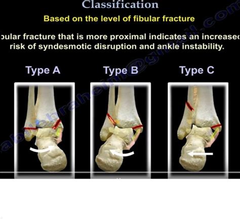 Danis Weber Classification of Ankle fractures — OrthopaedicPrinciples.com