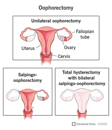 50 Unveiled Benefits of Keeping Cervix After Hysterectomy: 2024 Guide