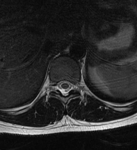 pastertecno.blogg.se - How to read mri images of thoracic spine