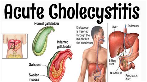 Acute Cholecystitis #Surgery #long_case #Viva #two_minutes_series - YouTube