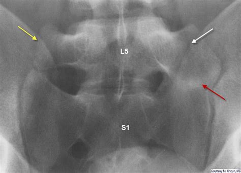 Learning Radiology - Transitional, Lumbosacral, Vertebra