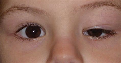 Ptosis, droopy eyelid causes, droopy eyelid treatment and ptosis surgery