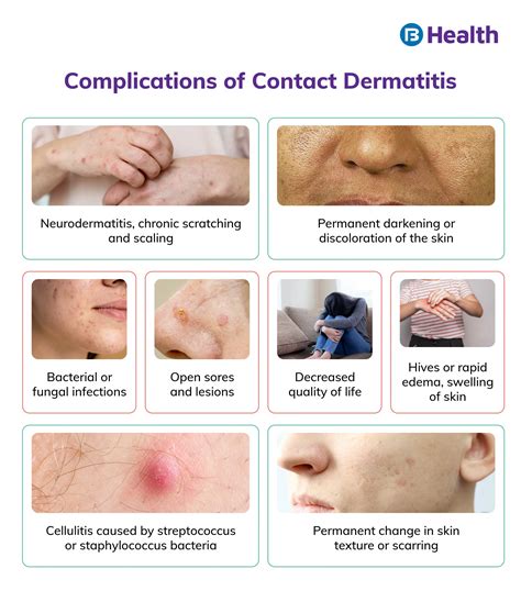 What causes contact dermatitis and how to treat it?