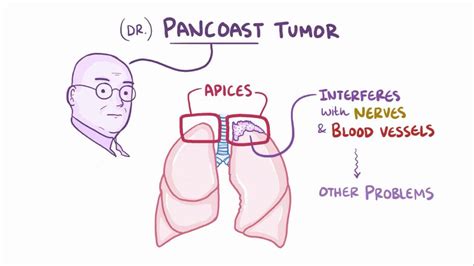 Pancoast tumor: Video, Anatomy, Definition & Function | Osmosis