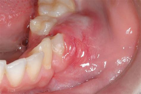 Ameloblastic fibrosarcoma of the mandible: case report and literature ...