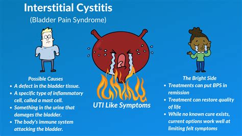 Interstitial Cystitis — Fairbanks Urology