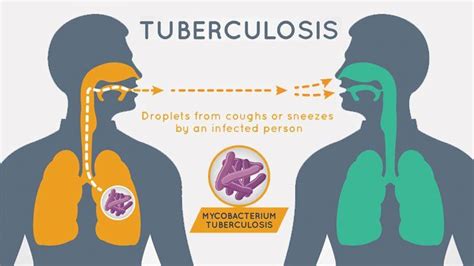 How To Control Tuberculosis - Creativeconversation4