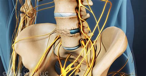 Degenerated Disc Surgery: Exploring Your Fusion and Pain Management Options