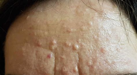 What Are These Small Bumps On My Face?- Sebaceous Hyperplasia By Joanna ...