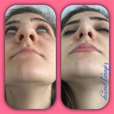 Rhinoplasty Surgery, Nose Surgery, Bulbous Nose, Rhinoplasty Before And ...