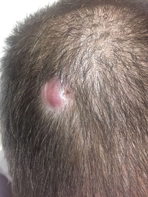 Isolated, 2.5 cm × 1 cm raised skin lesion on the scalp vertex ...