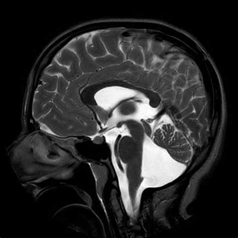 Isolated inferior vermian hypoplasia | Image | Radiopaedia.org