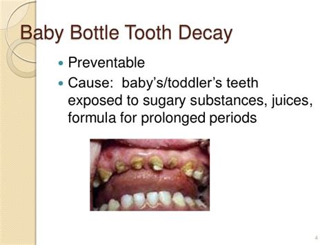 Baby bottle tooth decay