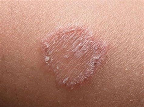 Ringworm: Ringworm Causes, Symptoms & Treatments