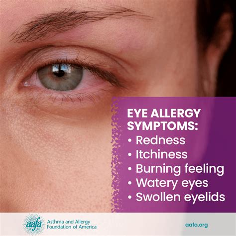 Eye Allergy / Allergic Conjunctivitis