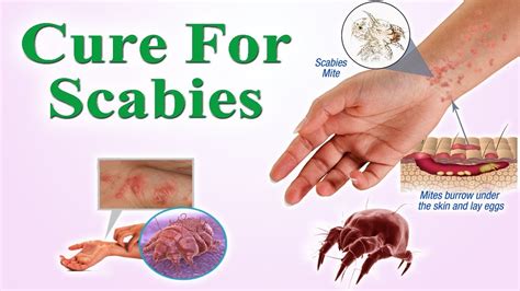 Scabies Causes Symptoms Pictures Of Rash And Treatment Everyday ...