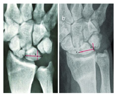 Postoperative (a) and 40 years after the osteotomy (b) radiographs of ...