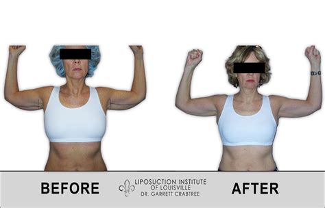 Female Arms Before & After Gallery - Liposuction Institute of ...