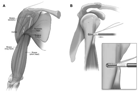 Biceps Tenodesis Procedure