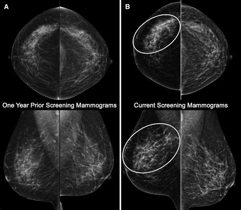 Prior (A) and current (B) bilateral screening mammograms in a ...